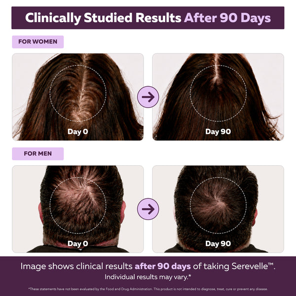Folura Serevelle Day 0 and Day 90 clinical results comparison showing scalp photos for men and women