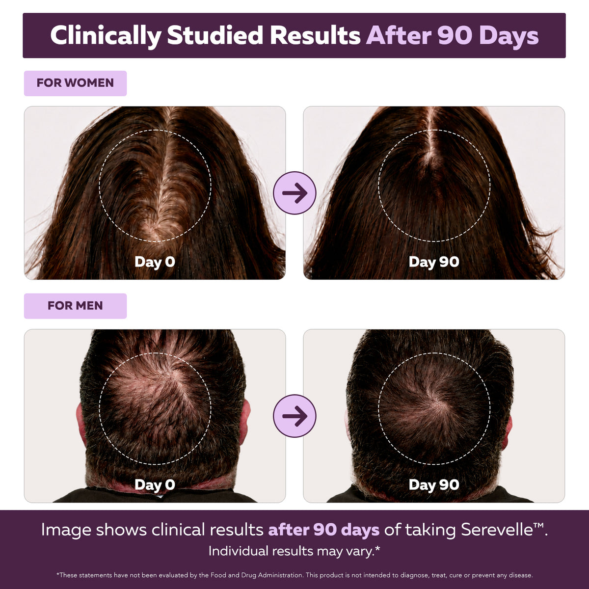 Folura Serevelle Day 0 and Day 90 clinical results comparison showing scalp photos for men and women