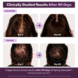 Folura Serevelle Day 0 and Day 90 clinical results comparison showing scalp photos for men and women