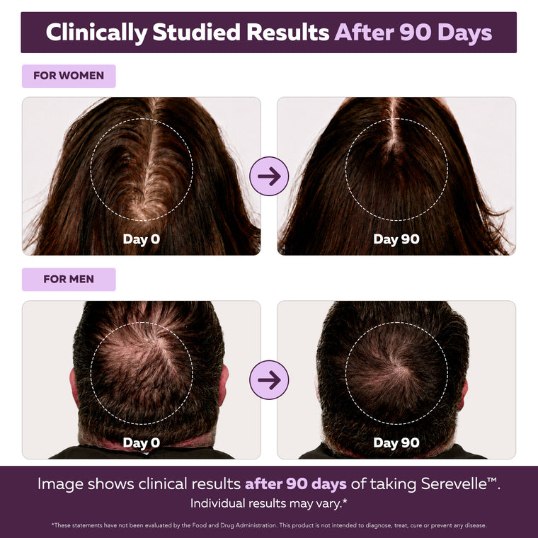 Folura Serevelle Day 0 and Day 90 clinical results comparison showing scalp photos for men and women